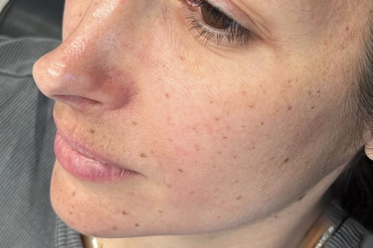 Micropigmentación de pecas con resultado natural en Málaga